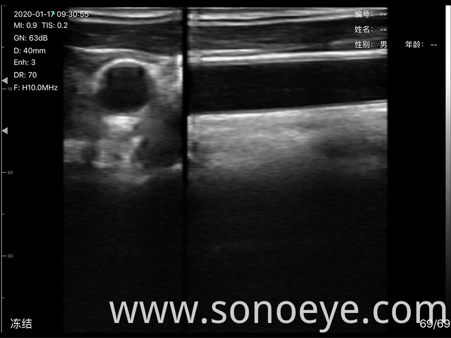 porket ultrasound